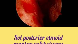 Sol posterior etmoid mantar enfeksiyonu Left posterior ethmoid fungal sinusitis [upl. by Ahsin]