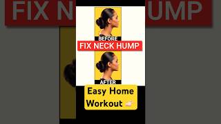 Fix Neck Hump at Home  Neck Pain Relief Exercises shorts youtubeshorts gymnoughtfitness [upl. by Ylhsa717]