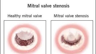 Mitral Stenosis Part 1 Anatomy amp Pathophysiology [upl. by Asirralc]