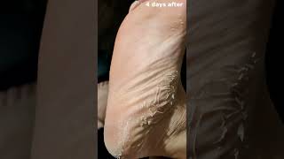 FOOT PEEL MASK DOES IT WORK shorts [upl. by Mendelsohn]