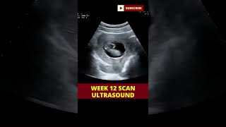 ultrasound scan week 12  pregnancy scan  week by week pregnancy [upl. by Muna868]