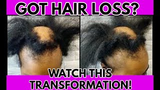 HAVE YOU TRIED THIS l PASSION TWIST l ALOPECIA l BALD SPOT COVER UP METHOD [upl. by Nyledaj926]