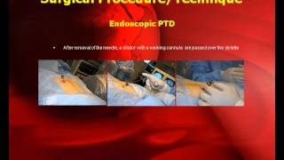 Posterolateral Endoscopic Thoracic Microdiscectomy with GPS System [upl. by Dehnel]