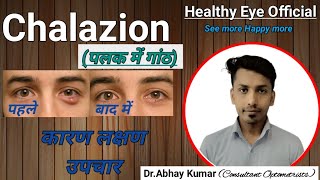 Chalazion treatment without surgery  पलक में गांठ को कैसे ठीक करें  how to get rid chalazion fast [upl. by Malda722]