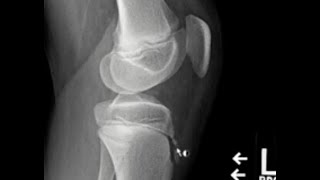 OsgoodSchlatter disease [upl. by Enoved693]