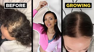 The BEST oils for hair growth  how to beat hair loss naturally for thicker hair [upl. by Swithbart809]