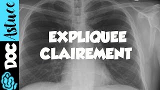 🔴 4 Dr Astuce  ANOMALIES RADIO THORAX EXPLIQUÉES CLAIREMENT  PARTIE 2 [upl. by Alec]