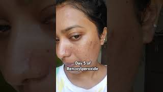 Day 5 of Benzoylperoxide benzoylperoxide skincare acne combinationskin skincareroutine pharma [upl. by Eiddet293]