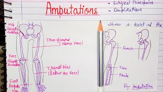 Amputation introduction indications types complications [upl. by Nytsuj]