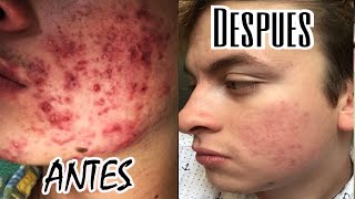 ELIMINA TU ACNÉ CON ISOTRETINOINA  MI HISTORIA DE ACNE — Heeysoycesar [upl. by Clim]