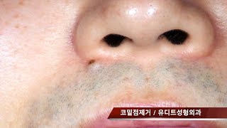 nevus removal surgery 코밑점제거 [upl. by Gigi]