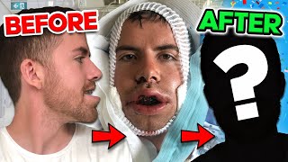 I HAD DOUBLE JAW SURGERY  My experience with an underbite Before and After [upl. by Tnilf]