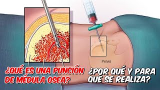 Qué es Punción de Médula Ósea  Biopsia de Médula Ósea Para qué se Reliza [upl. by Allix818]