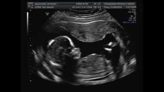 16 Weeks Pregnant Ultrasound [upl. by Whitman]