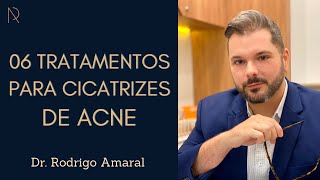 Dr Rodrigo Amaral  06 Tratamentos para cicatrizes de acne [upl. by Odlanra]