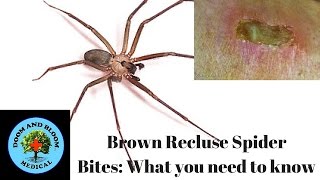 Brown Recluse Spider Bites What you need to know [upl. by Aundrea]