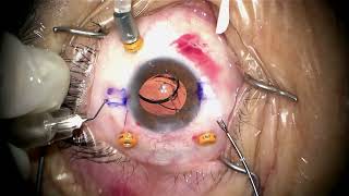 Removal of Lens bag complex on retina PPV Yamane with AR40 on 313mm eye by Steven G Safran MD [upl. by Tyra]