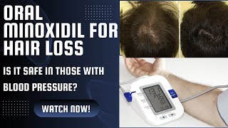 Minoxidil for hair loss  can we use in those with blood pressure [upl. by Hansel]