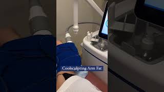 Coolsculpting for arm fat [upl. by Nirrok]