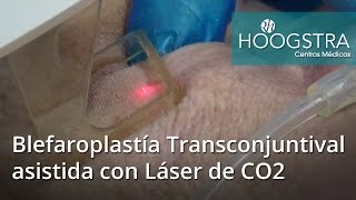 Blefaroplastía Transconjuntival asistida con Láser de CO2 16057 [upl. by Auqinahc]