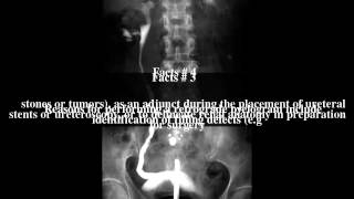 Retrograde pyelogram Top  7 Facts [upl. by Marcelle119]