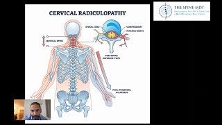 What is cervical radiculopathy How to treat it [upl. by Donnelly]