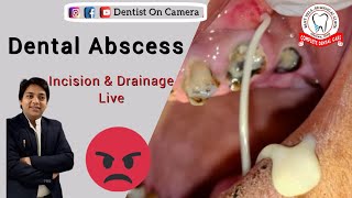 Huge Dentals abscess incision amp drainage [upl. by Tibold]