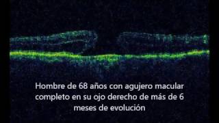 Cirugía de agujero macular  Nueva técnica con inducción de desprendimiento macular [upl. by Jarvis]