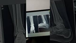 X ray ankle aplat 21years girl [upl. by Gerry]