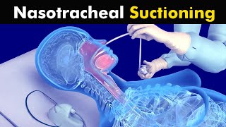 How Nasotracheal suction is performed [upl. by Eerrehs]