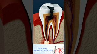 Root Canal Treatment Explained  How to Treat a Tooth Abscess Shorts [upl. by Alleuqram]