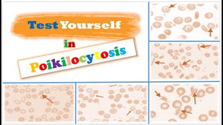 Review 📝  RBCs Morphological Abnormalities Poikilocytosis [upl. by Imnubulo462]