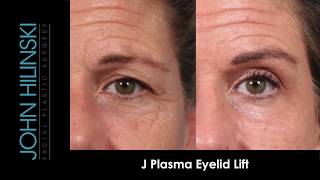 NonSurgical Eyelid Lift [upl. by Erait]