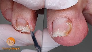 Nail trimming and control in a patient with walking difficulties Person close to 90 years old [upl. by Suchta]