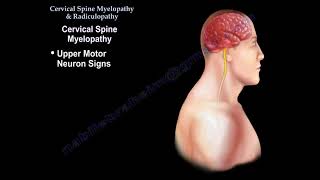 Cervical Spine Myelopathy amp Radiculopathy [upl. by Rise]