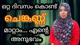 Natural home remedy for conjunctivitisചെങ്കണ്ണ് മാറാൻ How to remove Pink eye [upl. by Sioled231]