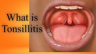 What is Tonsillitis Tonsils Kia hain Bachun me tonsils ka ilaj in UrduHindi [upl. by Lokim]