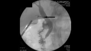 Intraoperative cholangiography [upl. by Nadda741]