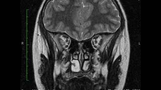 Miosite orbitária do recto externo do OD  RM CE T2 coronal [upl. by Ardnikal]
