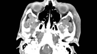 Mandibular Condyle Osteochondroma [upl. by Nonnelg]