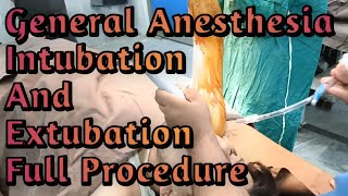 General Anesthesia Intubation amp Extubation Procedure  General Anesthesia  Anesthetic Waseem [upl. by Sadowski]