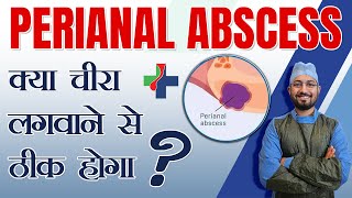 Perianal Abscess क्या चीरा लगवाने से ठीक होगा  Dr Anshul Shah PerianalAbscess fistulatreatment [upl. by Neeruan]