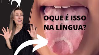 Isso na língua é grave😰 dentista dravanessagualda lingua [upl. by Retsevlys800]