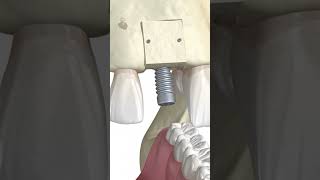 ASMR  Dental Implant  Bone Grafting  Oral Surgery  Part 2  shorts [upl. by Attecnoc]