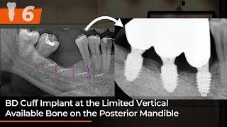 BD Cuff implant at the limited vertical available bone on the posterior Mandible [upl. by Naig]