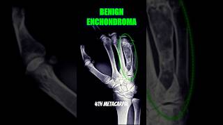 Enchondroma bones xray health [upl. by Bach743]