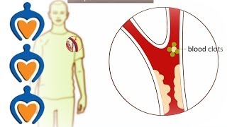 Thrombosis  What is it and how is it treated [upl. by Huesman]