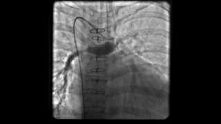 Central Shunt in Pulmonary atresia [upl. by Ennagroeg815]