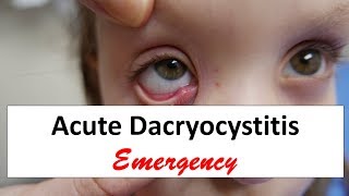 Acute Dacryocystitis Emergency [upl. by Etnauq]