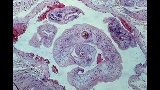 Schistosomiasis  Pathology mini tutorial [upl. by Harutak]